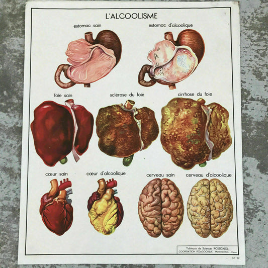 Vintage French Medical Poster Anatomy Alcoholism Vision Rossignol 1612193 Fleamarketfrance